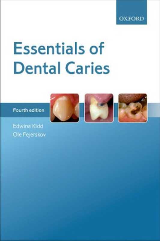 Essentials of Dental Caries（Edwina Kidd; Ole Fejerskov）（Oxford University Press 2016）